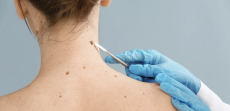 Where to Book a Same-Day Skin Check Appointment in Arlington